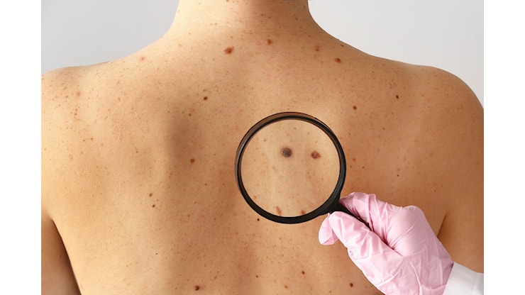 Melanoma, al Policlinico di Messina visite dermatologiche gratuite con “Save Your Skin” - 98zero