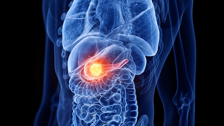 La scienza ha trovato come colpire il tumore impossibile. La cura del cancro al pancreas a un punto di svolta (di L.Varlese) - HuffPost Italia
